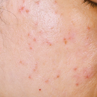Acne Prone Skin