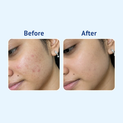 Before and after comparison of a woman's facial skin, showing acne and blemishes on the left ('Before') and clearer, smoother skin on the right ('After') against a light blue background.