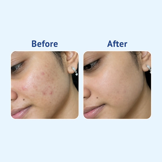 Before and after comparison of a woman's facial skin, showing acne and blemishes on the left ('Before') and clearer, smoother skin on the right ('After') against a light blue background.