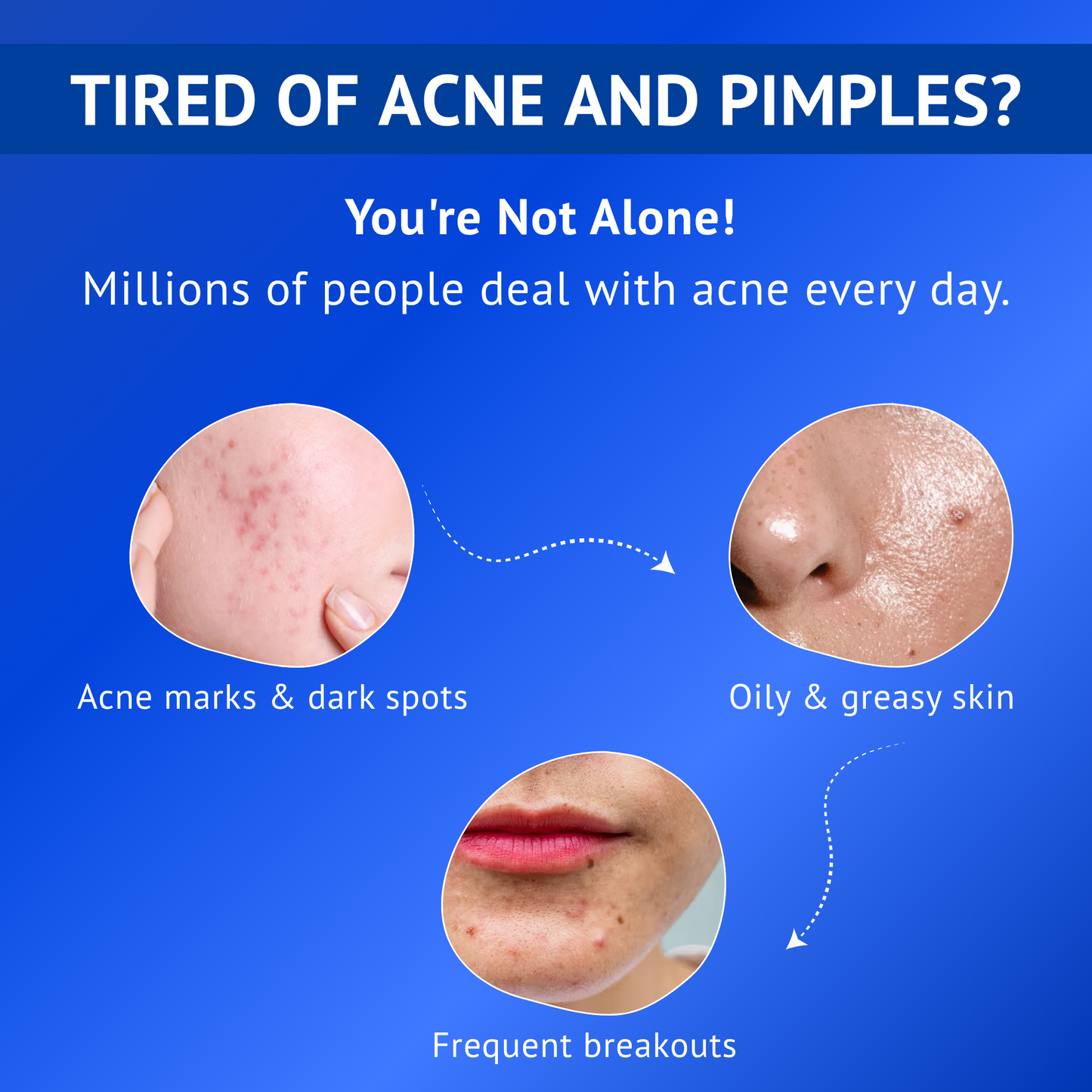Anti-Acne Skincare Kit Combo