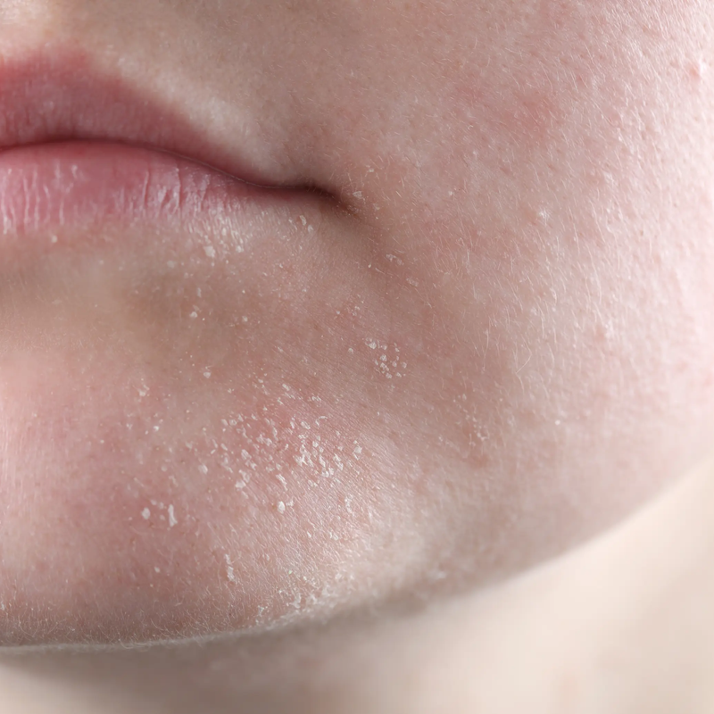 Dry Skin