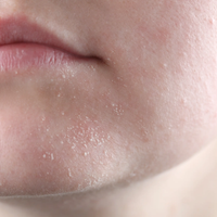 Dry Skin