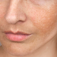 Dull Skin