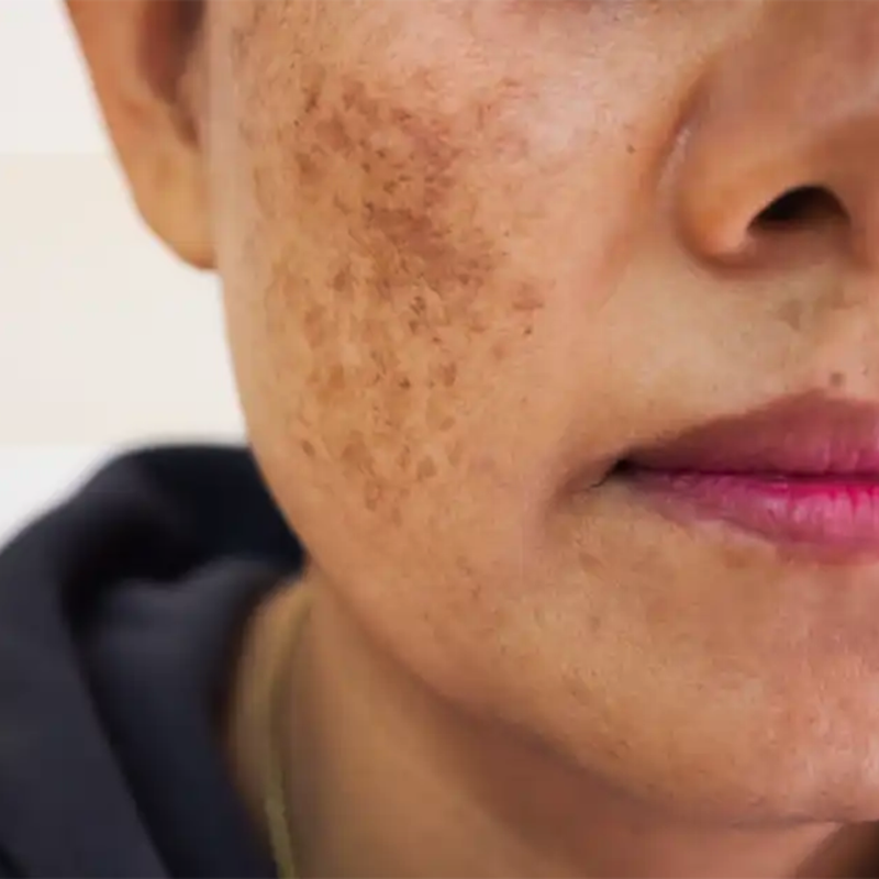 Hyper-Pigmentation