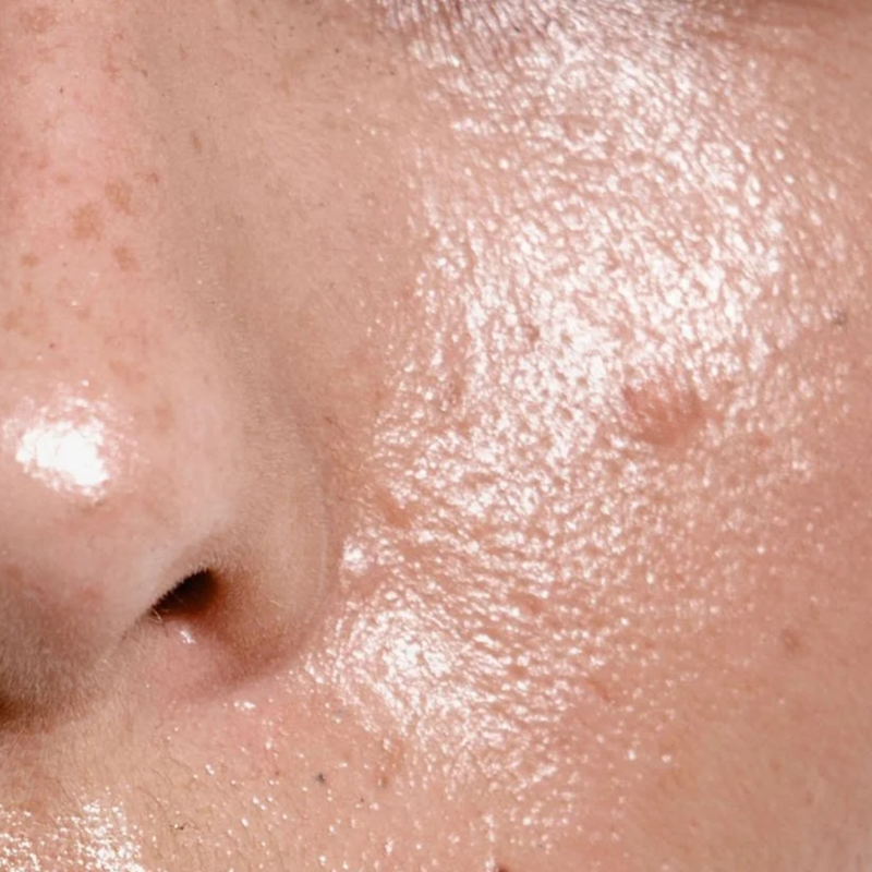 Oily Skin