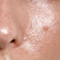 Oily Skin