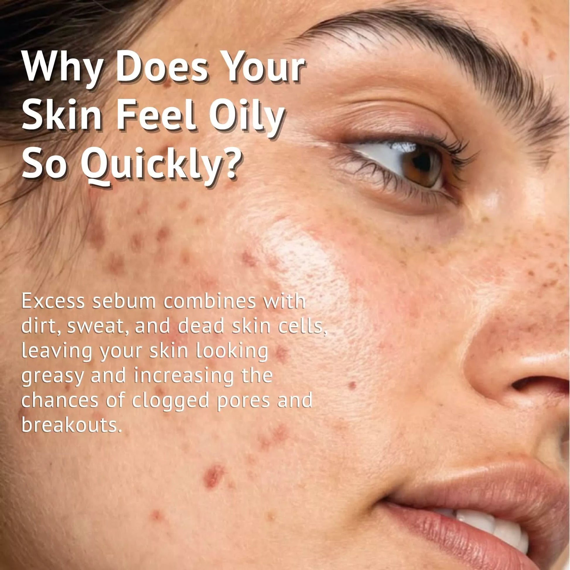 Why Is My Face So Oily? Common Causes & Solutions | Qtways
Oily Skin Causes, Prevention & Daily Skincare Routine | Qtways India
How to Control Excess Oil on Your Face Naturally | Qtways
Best Skincare for Oily & Acne-Prone Skin | Qtways India