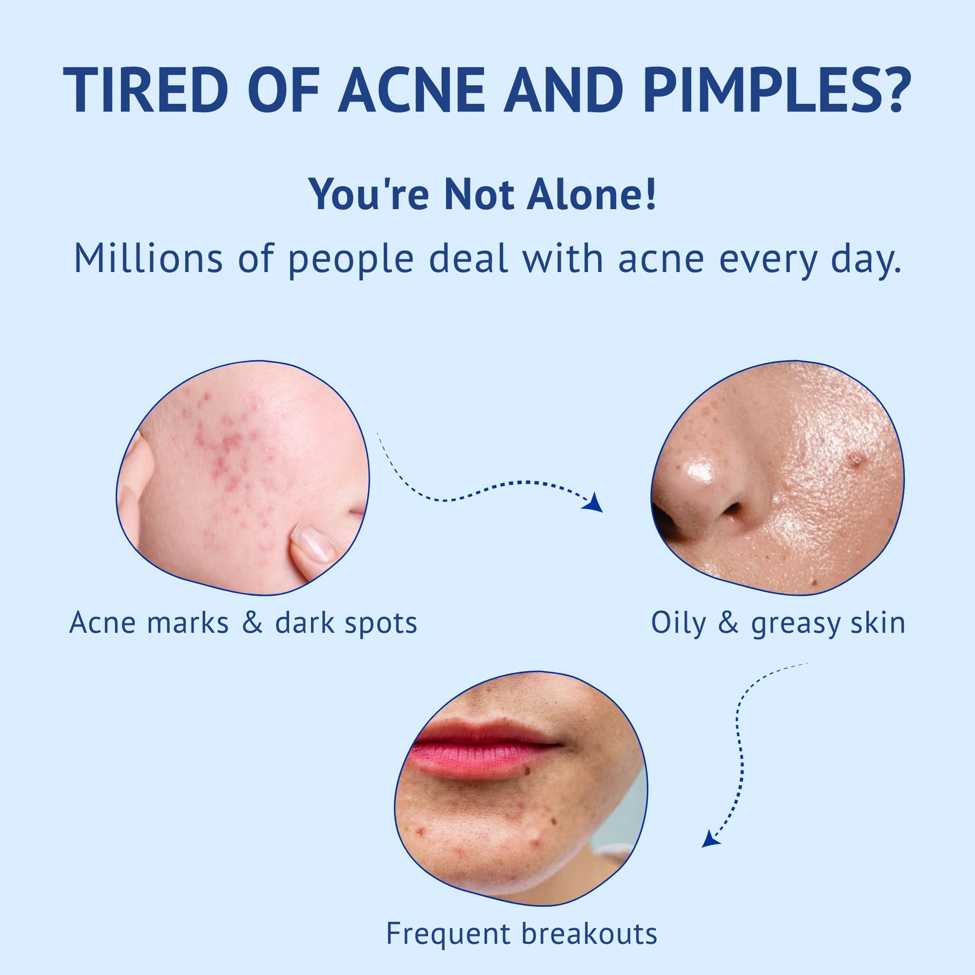 Problem-aware infographic titled Tired of Acne and Pimples? You're Not Alone! for QTWAYS Anti-Acne Kit in India. It illustrates three major skin concerns with close-up facial visuals: Acne marks & dark spots, Oily & greasy skin, and Frequent breakouts.