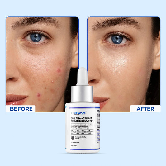 Before and after comparison side-by-side showing clearer, smoother, and glowing skin with reduced acne and dark spots after using QTWAYS 30% AHA + 2% BHA Peeling Solution in India.