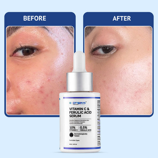 Before and after comparison side-by-side showing brighter, clearer, and glowing skin with reduced dark spots and acne marks after using QTWAYS Vitamin C & Ferulic Acid Serum in India.