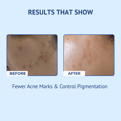 Infographic titled Results That Show for QTWAYS Niacinamide + Kojic Acid & Vitamin B5 Face Serum in India, displaying side-by-side Before and After close-up images demonstrating fewer acne marks and controlled pigmentation.
