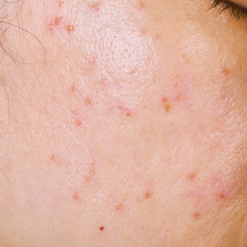 Acne Prone Skin