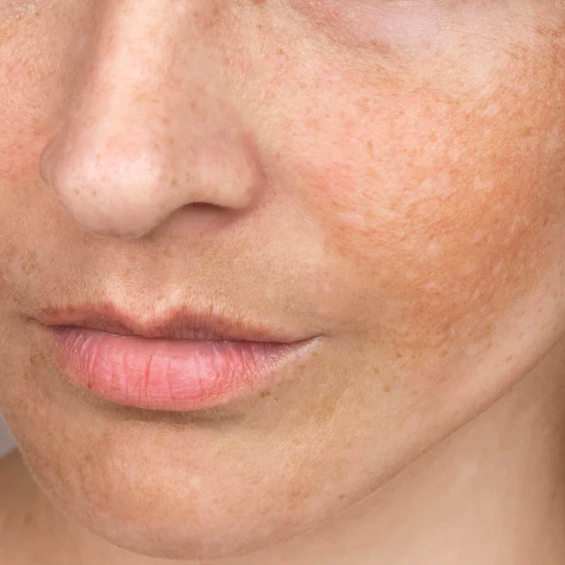Dull Skin