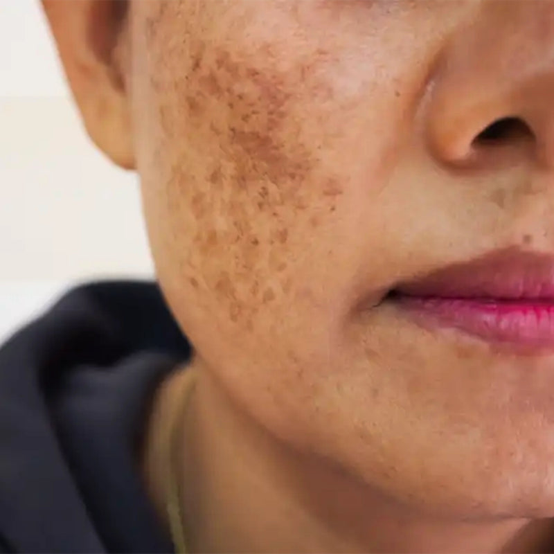 Dark Spots & Hyperpigmentation