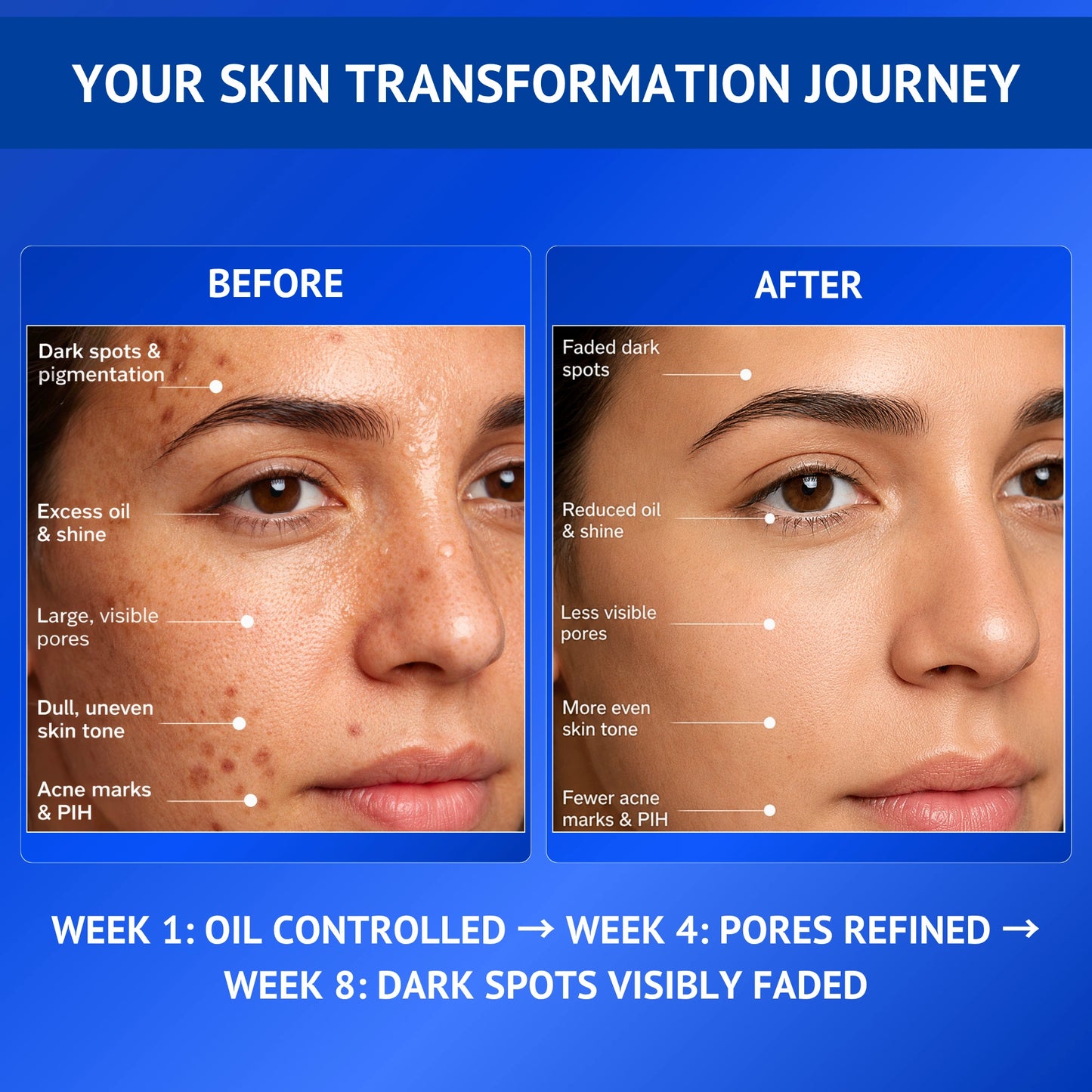 Before and after skin transformation infographic for Qtways 10% Niacinamide, 1% Kojic Acid and Vitamin B5 Face Serum showing reduction in dark spots, excess oil, visible pores, acne marks and post-inflammatory hyperpigmentation with improved skin tone over eight weeks.