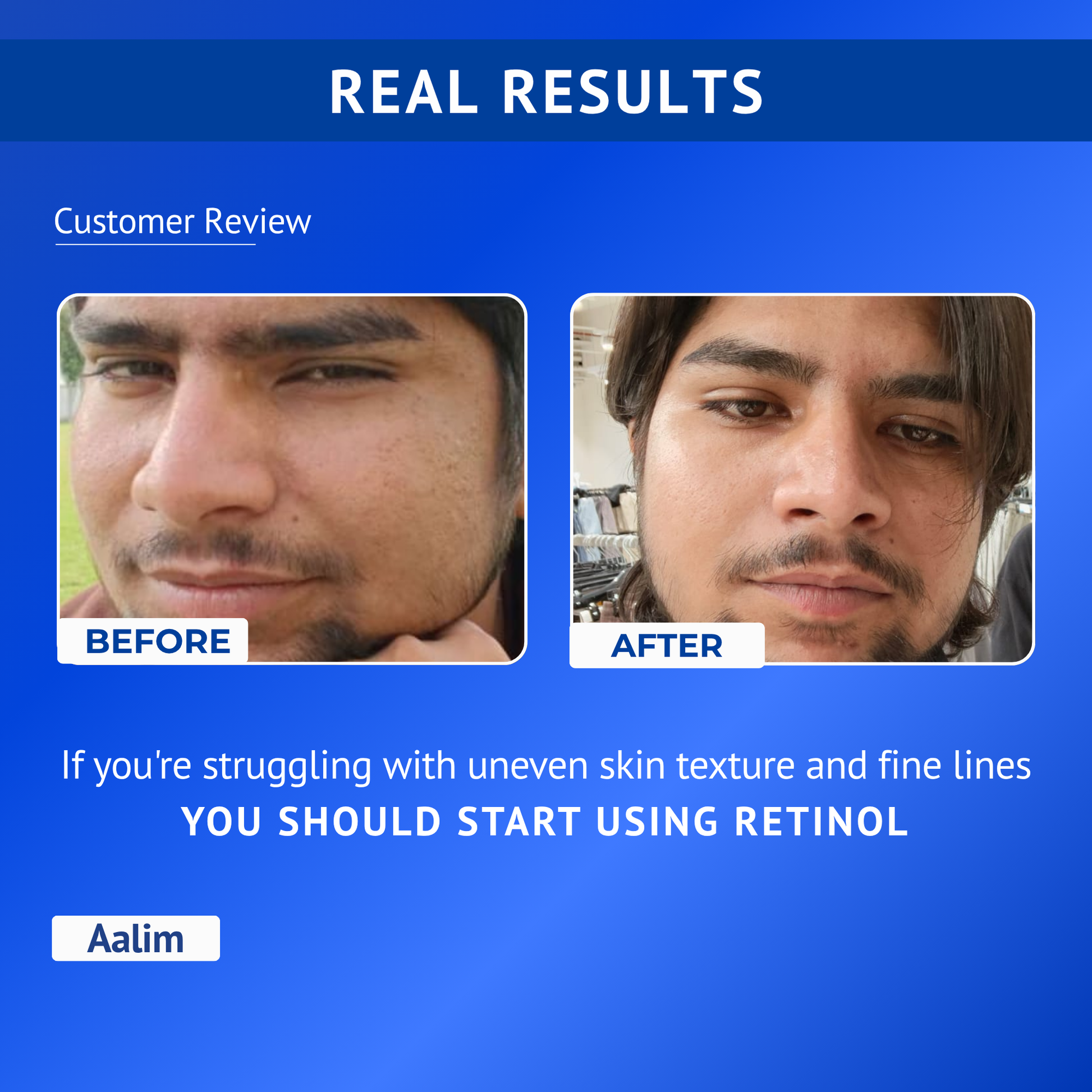 Before and after comparison showing smoother and refined skin texture after 4 to 8 weeks of using Qtways 0.3% Retinol Serum. Dermatologically tested anti-aging serum formulated with Retinol, Bakuchiol, Coenzyme Q10 and Vitamin E to improve skin texture and reduce visible signs of aging.
