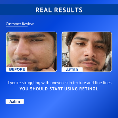 Before and after comparison showing smoother and refined skin texture after 4 to 8 weeks of using Qtways 0.3% Retinol Serum. Dermatologically tested anti-aging serum formulated with Retinol, Bakuchiol, Coenzyme Q10 and Vitamin E to improve skin texture and reduce visible signs of aging.