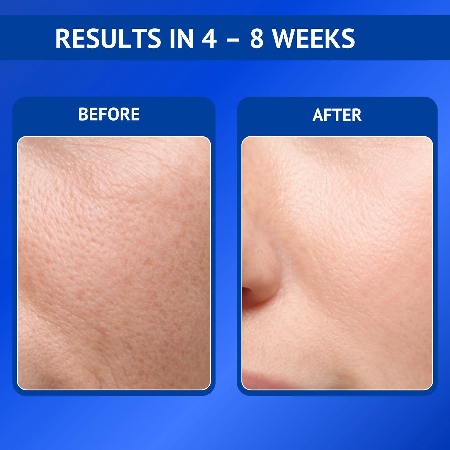 Before and after comparison showing smoother and refined skin texture after 4 to 8 weeks of using Qtways 0.3% Retinol Serum. Dermatologically tested anti-aging serum formulated with Retinol, Bakuchiol, Coenzyme Q10 and Vitamin E to improve skin texture and reduce visible signs of aging.