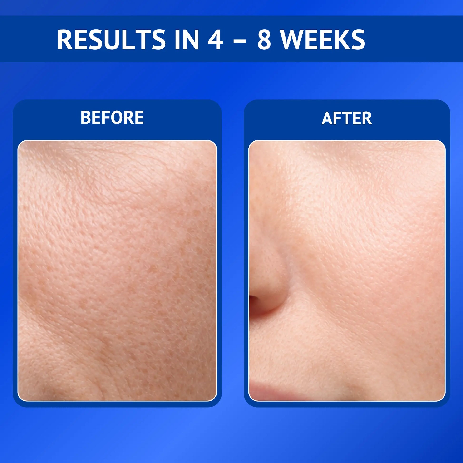 Before and after comparison showing smoother and refined skin texture after 4 to 8 weeks of using Qtways 0.3% Retinol Serum. Dermatologically tested anti-aging serum formulated with Retinol, Bakuchiol, Coenzyme Q10 and Vitamin E to improve skin texture and reduce visible signs of aging.