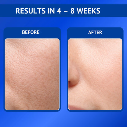 Before and after comparison showing smoother and refined skin texture after 4 to 8 weeks of using Qtways 0.3% Retinol Serum. Dermatologically tested anti-aging serum formulated with Retinol, Bakuchiol, Coenzyme Q10 and Vitamin E to improve skin texture and reduce visible signs of aging.