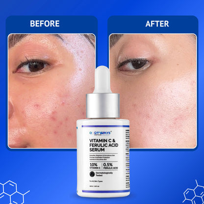 Before and after comparison showing improved skin clarity and reduced appearance of acne marks with Qtways 10% Vitamin C and 0.5% Ferulic Acid Serum, designed to brighten and smooth skin for all skin types.